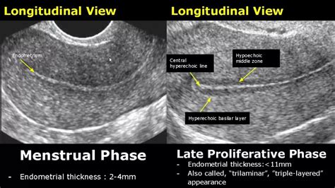 endometrial thickness measurement|normal endometrial thickness ultrasound.